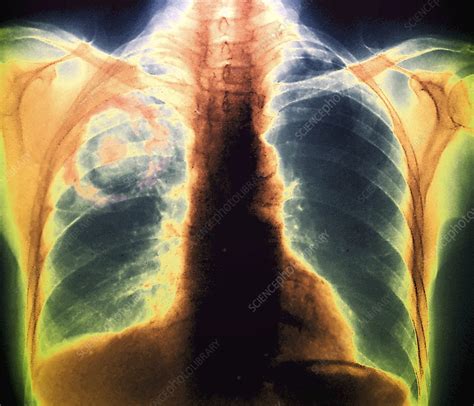Pulmonary Aspergillosis X Ray Stock Image M1080626 Science