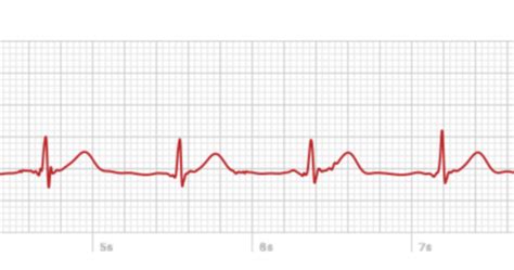 A Look At The Apple Watchs Ecg From Someone Who Needs It Hitbsecnews