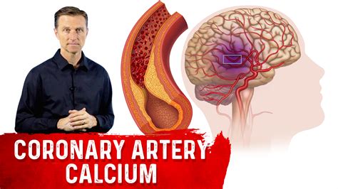 How To Read A Cac Score Healthy Keto™ Dr Berg