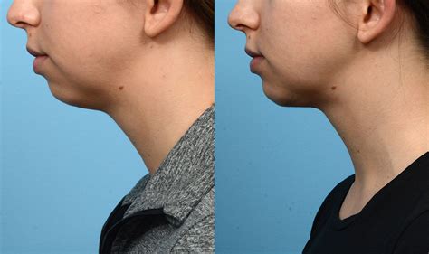 Chin Implants In New Jersey Wise Center For Plastic Surgery