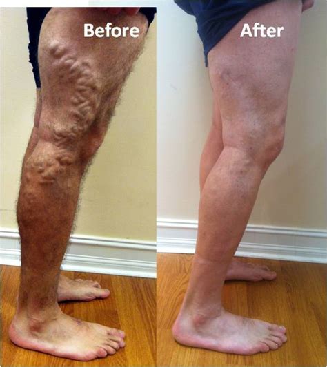 Does Blue Shield Of California Cover Varicose Vein Treatment East