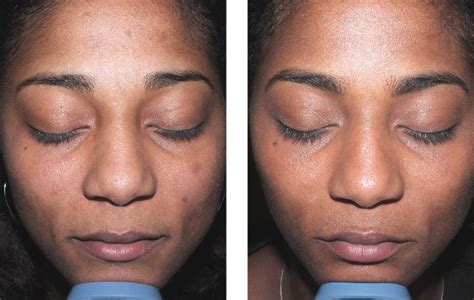 Chemical Peels Before And After Women Of Color