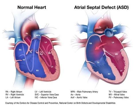 The Normal And Abnormal Heart Valves Are Shown In This Diagram Which