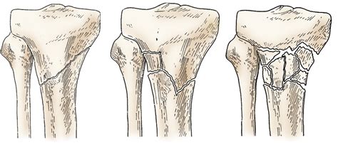 Less soft tissue covers fracture. Fractures of the Proximal Tibia (Shinbone) - OrthoInfo - AAOS