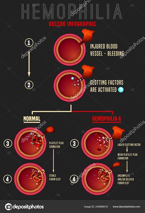 Hemophilia Blood Clotting Process Stock Vector Image By Annyart
