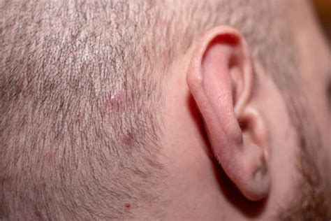 How To Treat Ingrown Hair On Scalp Easy Care Tips Bald And Beards
