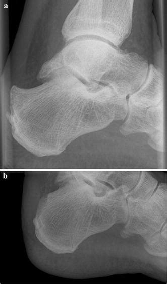 Endoscopic Calcaneoplasty ECP As A Surgical Treatment Of Haglunds