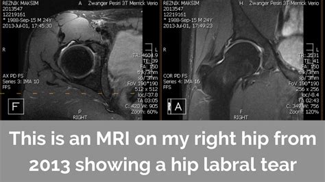 Why Your Hip Labral Tear Diagnosis Shouldnt Scare You