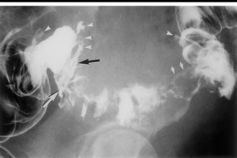 Right Anterior Oblique Double Contrast Barium Enema Radiograph Of The