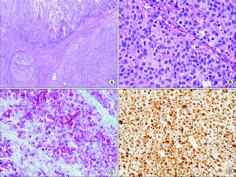Histologic Feature Of Malignant Melanoma A The Lesion Shows Diffuse
