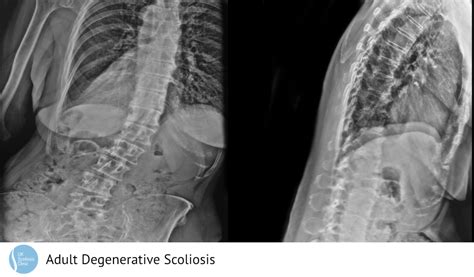 De Novo Scoliosis Archives Scoliosis Clinic Uk Treating Scoliosis