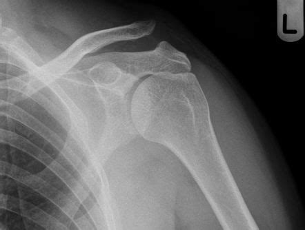 Acromioclavicular Joint Injury Radiology Reference Article Radiopaedia Org