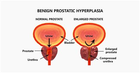 Pathophysiology Of Benign Prostatic Hyperplasia Hot Sex Picture