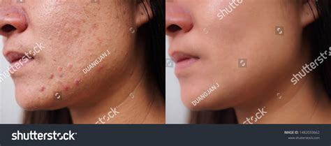 Image Before After Spot Red Scar Stock Photo 1482033662 Shutterstock
