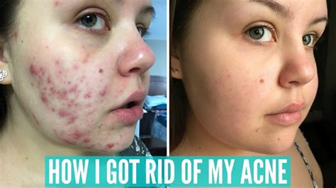 Bad Acne Skin