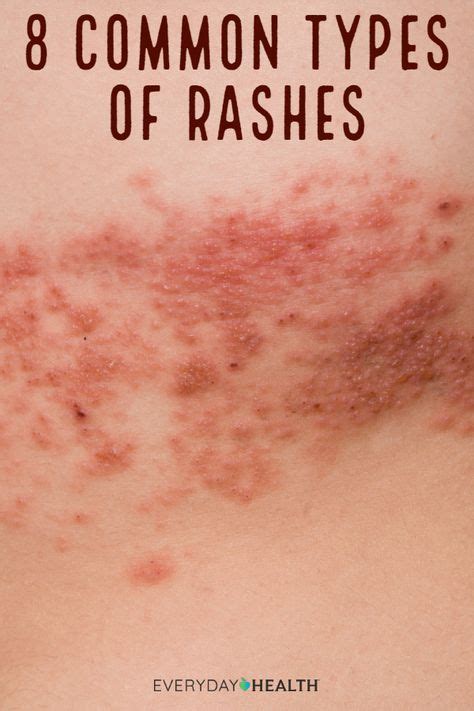 Common Types Of Rashes Skin Beauty Hair Types Of Rashes Contact Dermatitis Skin Rash