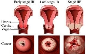 Treatment for cervical cancer depends on several factors, such as the stage of the cancer, other health problems you may have and your preferences. Cervical Cancer Treatment - Dr Lisa Wong - Mount Elizabeth ...