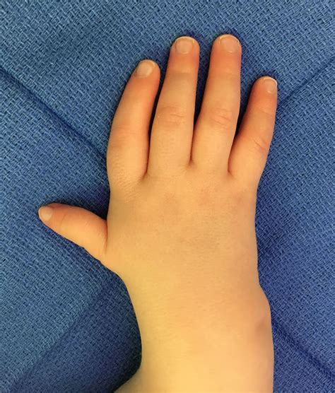 Thumb Deformity Congenital Hand And Arm Differences Washington