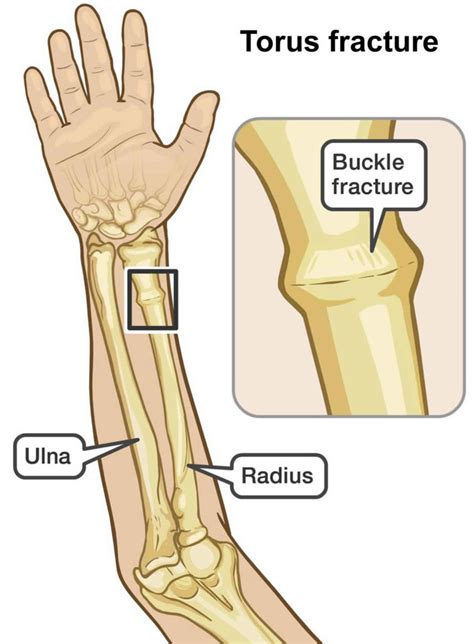 Buckle Fracture Causes Symptoms Diagnosis And Treatment