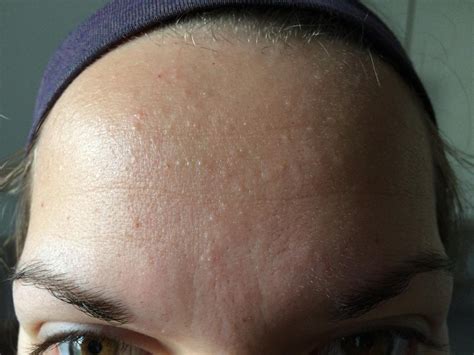 Small Flesh Colored Bumps On Forehead And Hairline Adult Acne Acne