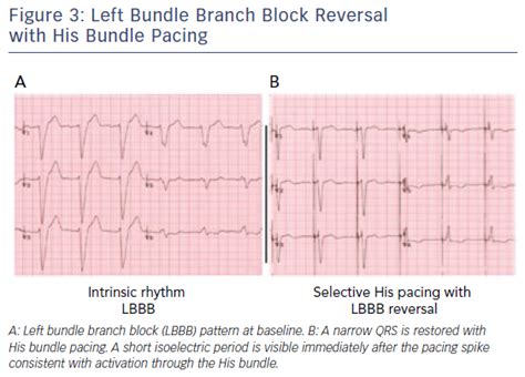 Figure Left Bundle Branch Block Reversal With His Bundle Pacing Radcliffe Cardiology