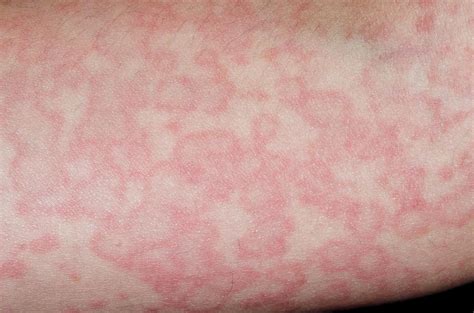 Urticaria Reaction To Viral Infection Photograph By Dr P Marazzi