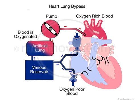 Heart Lung Bypass