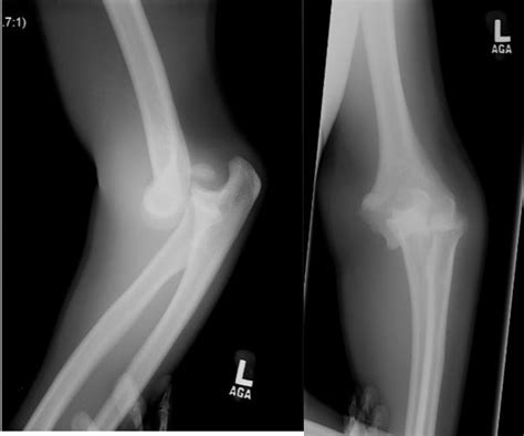 Anterior Elbow Fracture Dislocation With Ulnar Nerve Palsy In A Six