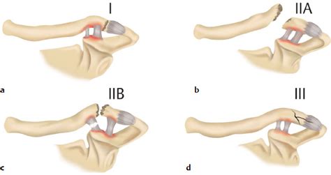 Trauma | Musculoskeletal Key