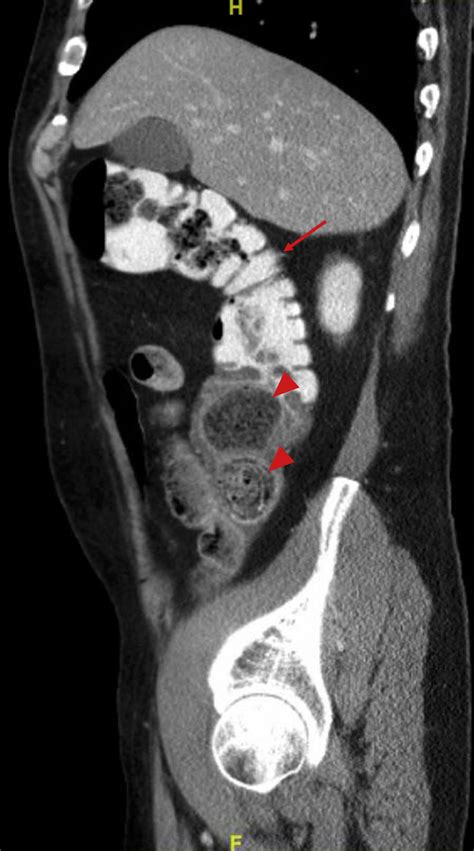 Sagittal Reformats Of An Abdominal Ct Scan Performed With Iv Oral And
