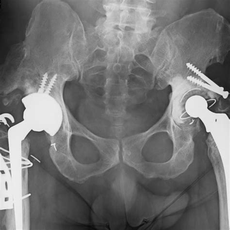 Anteroposterior Radiograph Of The Pelvis Showing The Results Of The