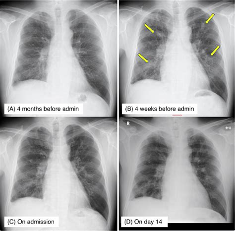 Chest Radiographic Images Of The Patient Chest X Ray Images 4 Months