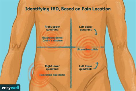 What Inflammatory Bowel Disease Pain Feels Like