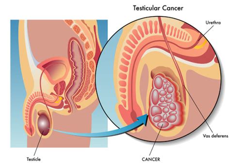 Identify Testicular Cancer Symptoms University Health News