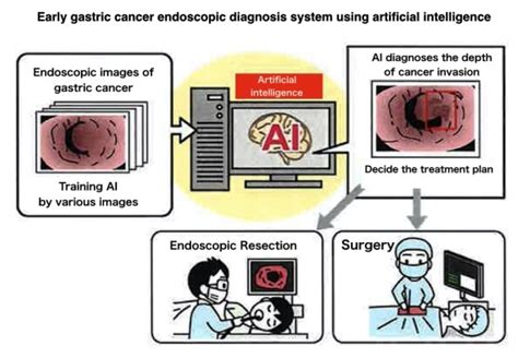 Researchers Use Ai To Develop Early Gastric Cancer Endoscopic Diagnosis
