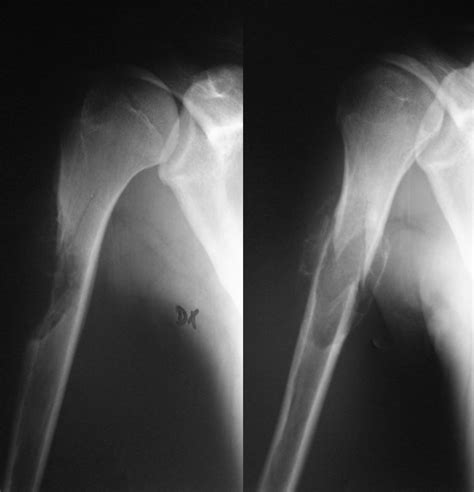 Aneurysmal Bone Cyst Of The Humerus A Report Of A Case Resolved By A