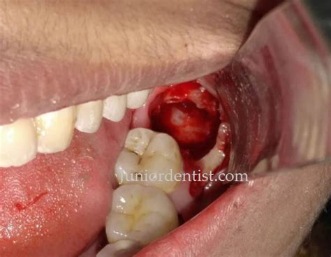 Keep in mind that you shouldn't. Care to be taken immediately after Wisdom tooth extraction