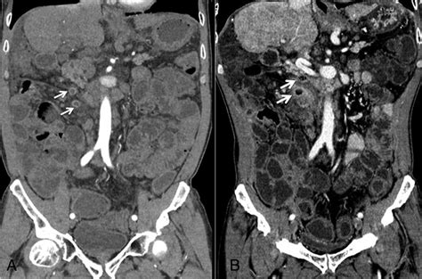 A Abdominal Computed Tomography Ct 1 Year Prior Showing The