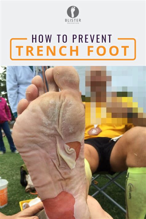 Maceration Part 3 Preventing Trench Foot Prevention Feet Treatment