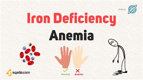 Iron Deficiency Anemia Overview Causes Pathophysiology 48 Off