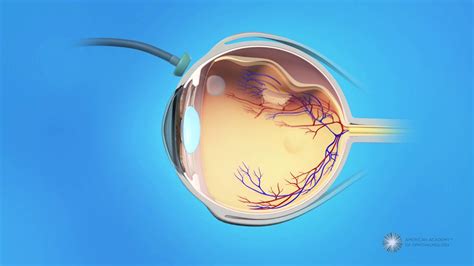 Vitrectomy Surgery For Detached Retina Youtube
