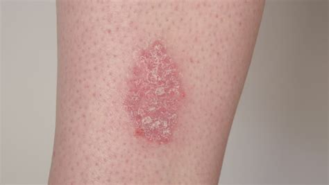 Close Up Flaky Skin On Unrecognizable Psoriasis Patient Slowly Peeling
