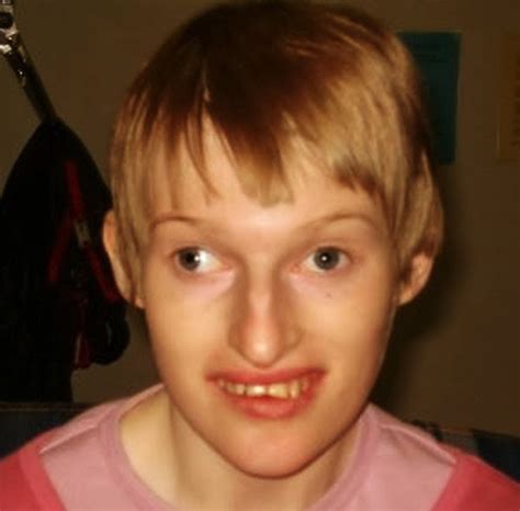 Medical Treatment Pictures For Better Understanding Angelman Syndrome