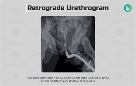Retrograde Urethrogram Rgu X Ray Procedure Purpose Results Normal Range Cost Price