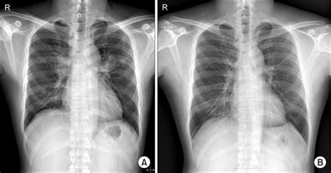 Initial Chest X Ray Shows Bilateral Hilar Prominence Raising The