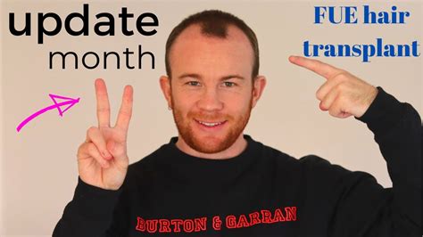 Month Hair Transplant Update Fue Youtube