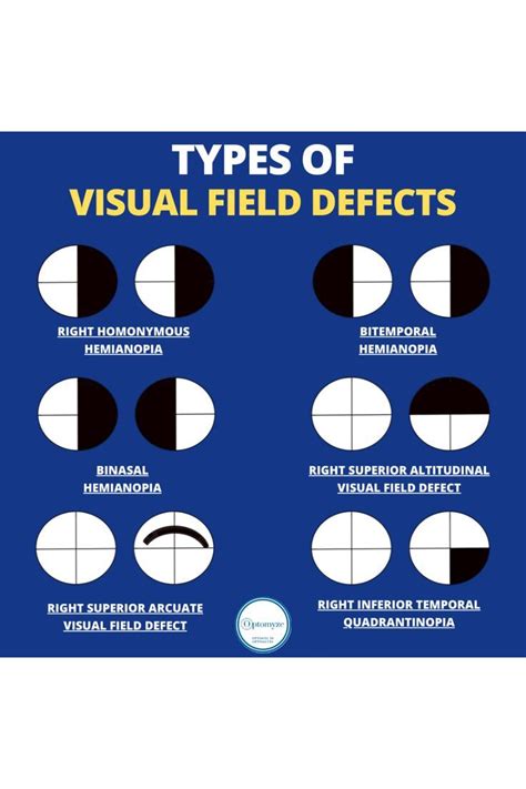Visual Field Defects Optometry Optometry Education Optometry
