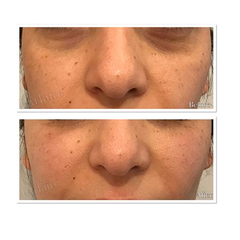 Before And After Cosmetic Treatment Gallery Parfaire Medical Aesthetics