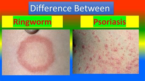 Difference Between Ringworm And Psoriasis Youtube