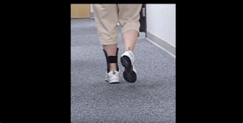 Video Richie Brace Considerations For Drop Foot With Before And After